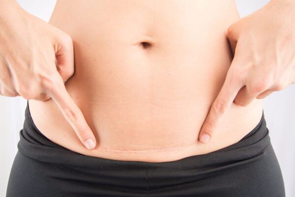 Cesarean Delivery Video