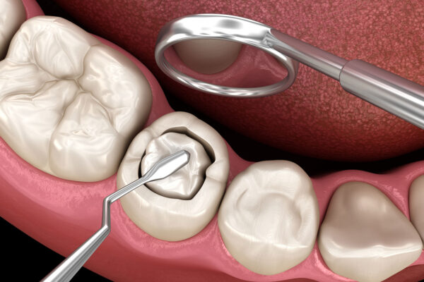 Composite Filling
