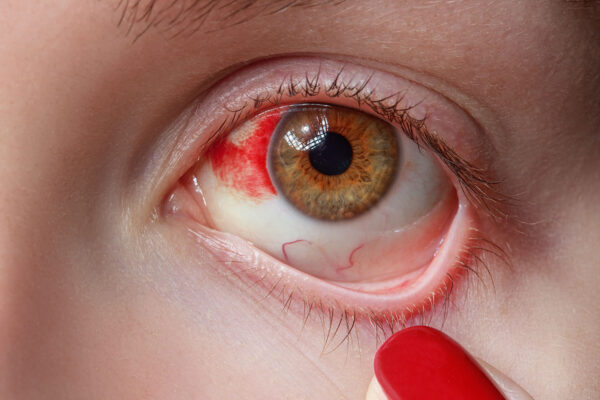 Conjunctivitis Precautions