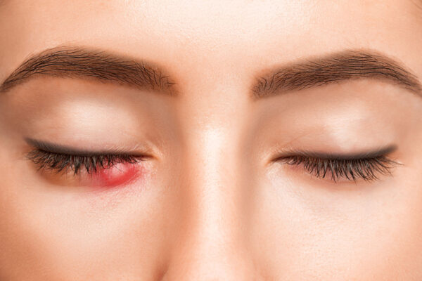 Conjunctivitis Prevention