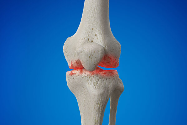 High Tibial Osteotomy