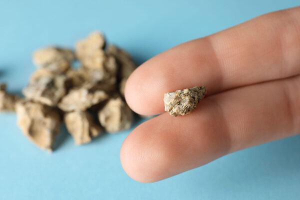Kidney Stones Pictures