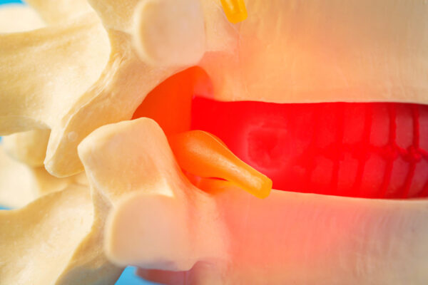 Lumbar Spondylosis Treatment