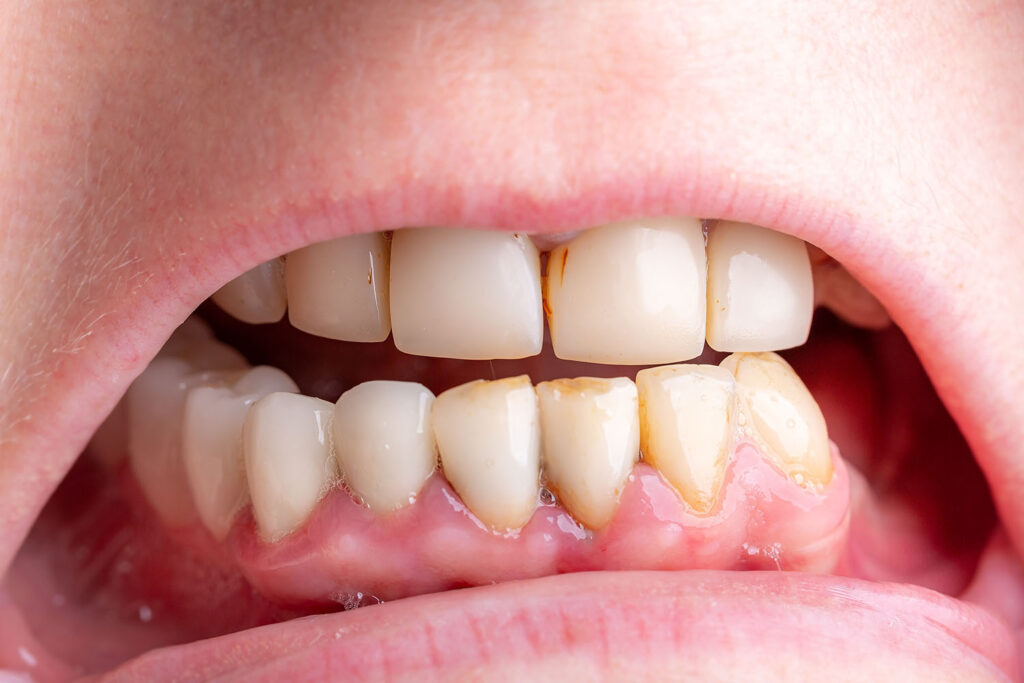 Tooth Cavity Images - Eremedium