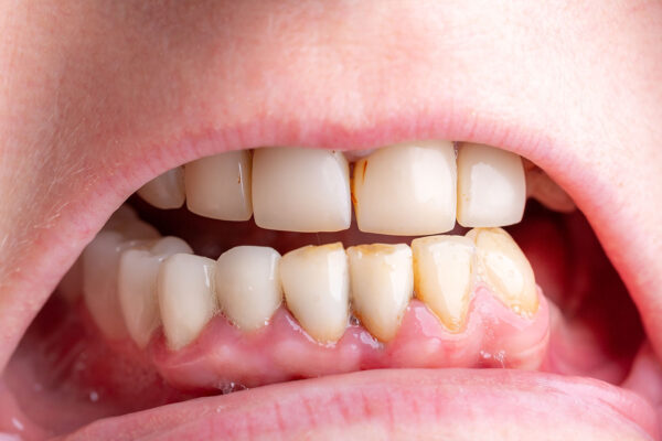Tooth Cavity Images