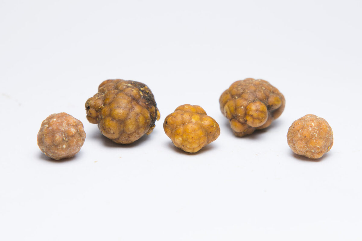 Which size of Gallbladder Stone is dangerous - Eremedium