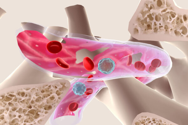 Bone Marrow Biopsy Scar