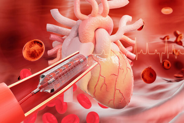 Bypass Surgery Video