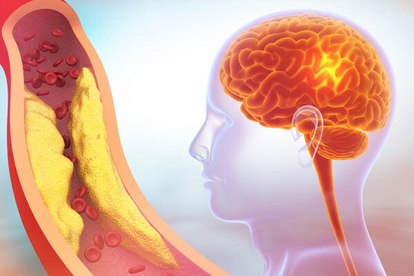 Carotid Artery Revascularization