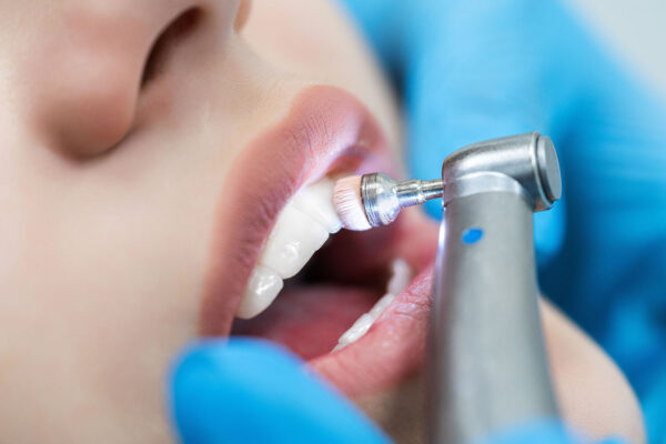 Dental Cleaning