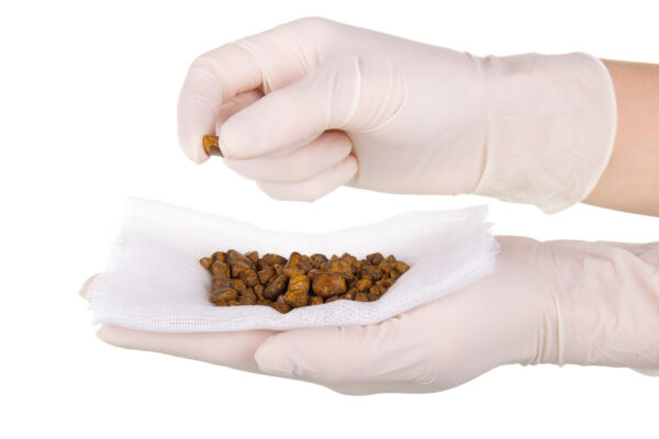 Gallbladder Stone Images