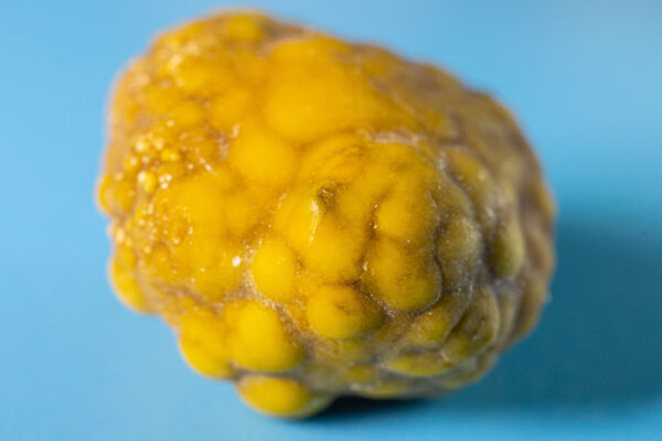 Gallbladder Stone Removal Surgery