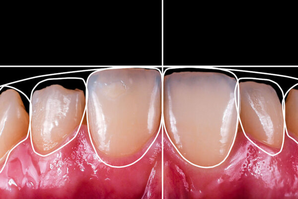 Implant Meaning