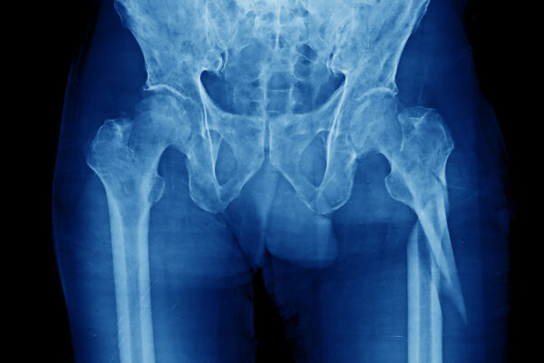 Subtrochanteric Fracture